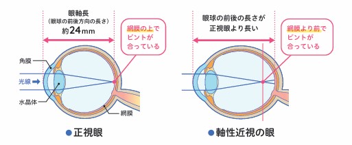 近視の進行を抑制するしくみ