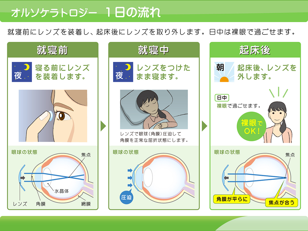 オルソケラトロジー 奈良市押熊町の眼科 コンタクトレンズ処方 オルソケラトロジー 小児の近視進行抑制 こぎし眼科クリニック